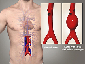 Abdominal Aortic Aneurysm Endovascular Repair